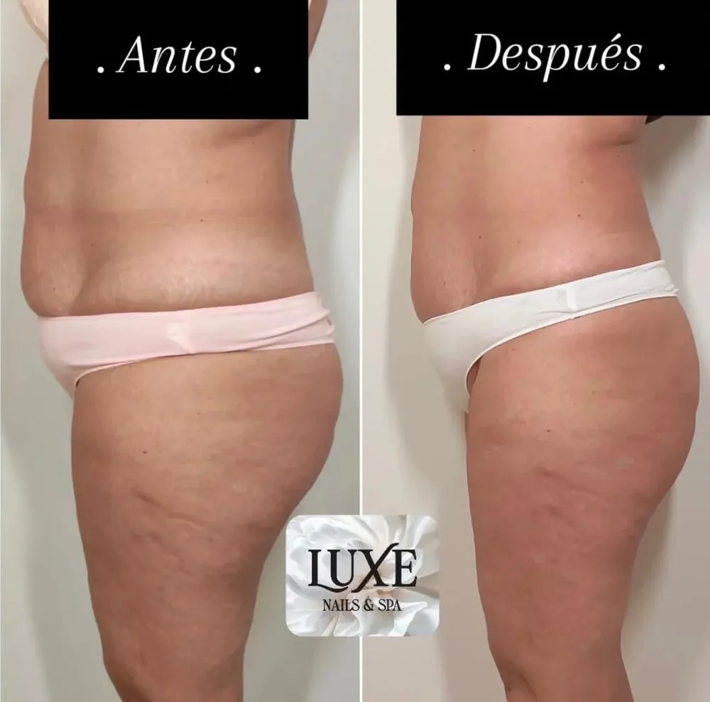 Antes y después de un tratamiento corporal realizado en el salón